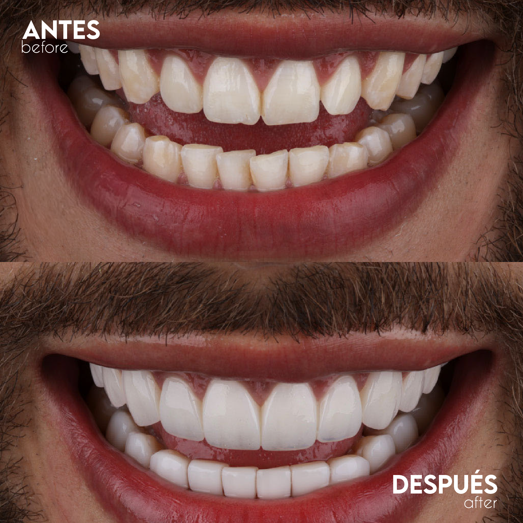 Caso Cerámica - Antes y Después
